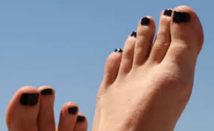 Uñas negras en los pies: qué hacer y tratamiento para corredores